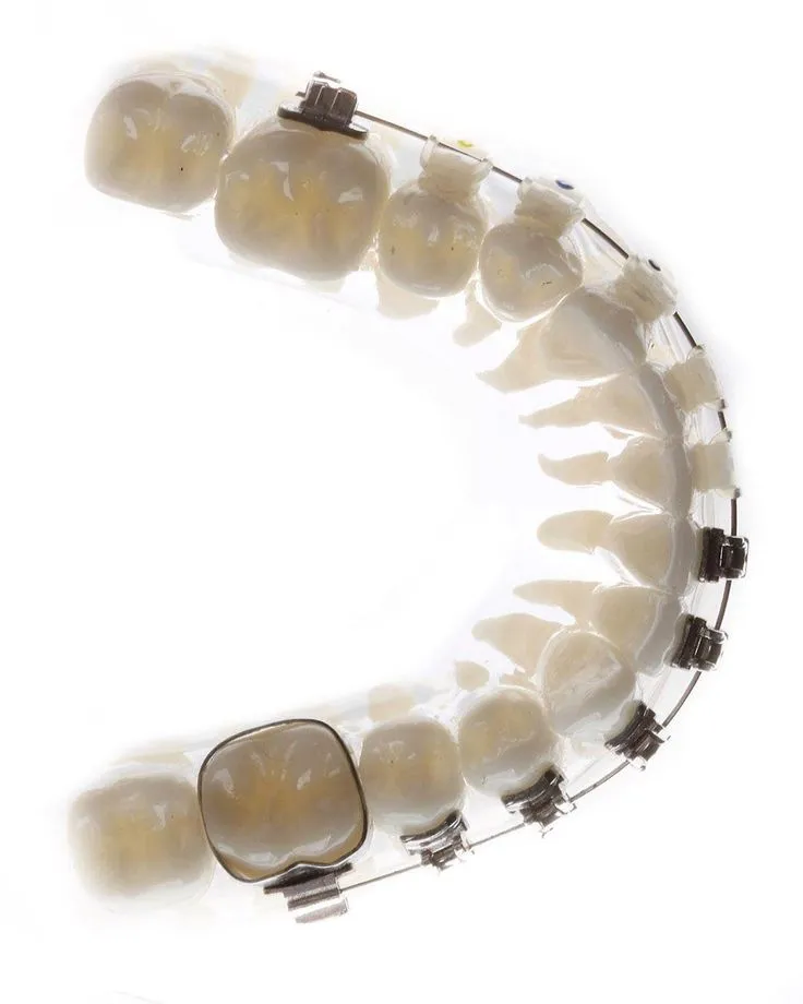 Modello di arcata dentale con apparecchio ortodontico